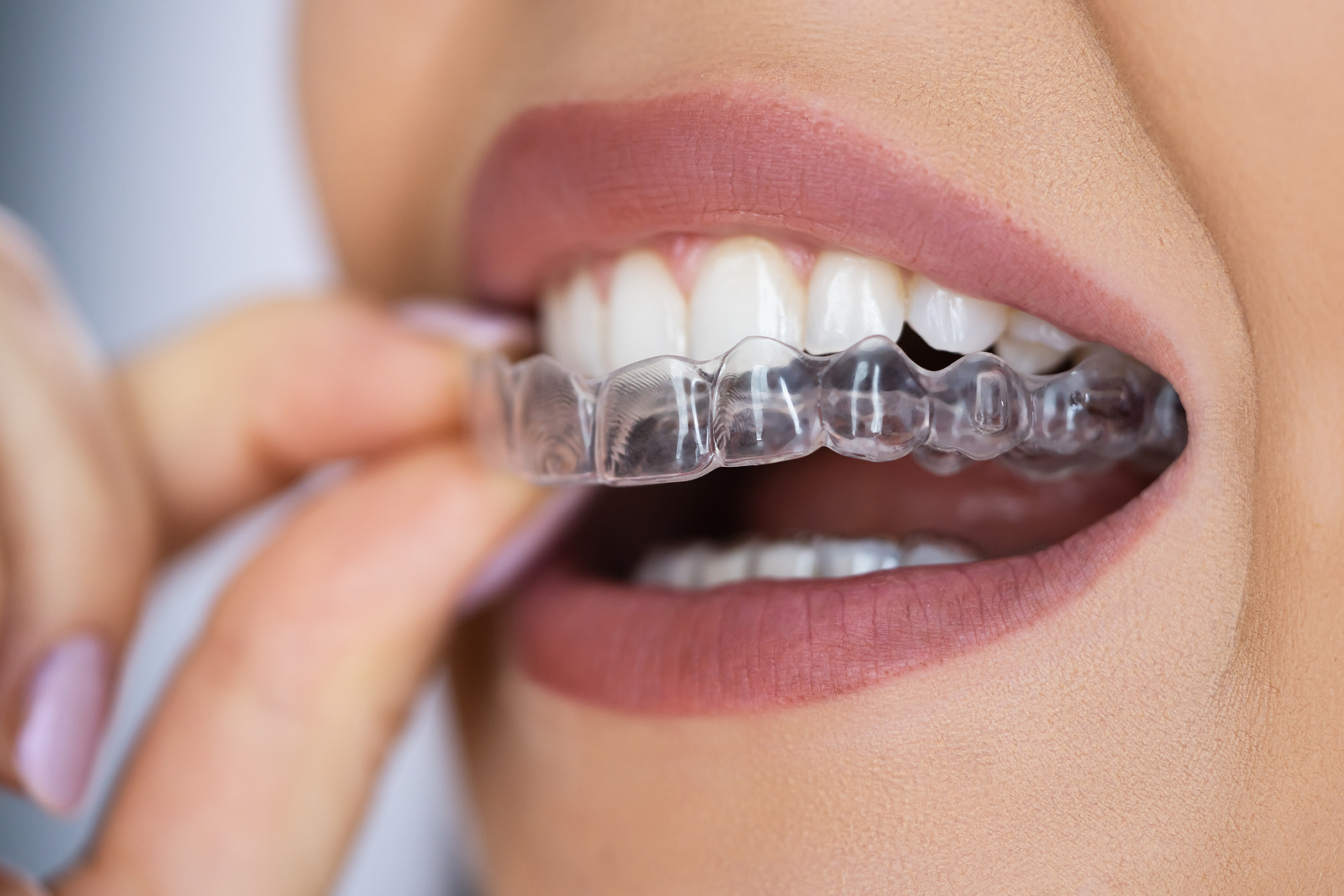 Transform Your Smile with Sure Smile Clear Aligners in Salem, OR: A Comprehensive Guide