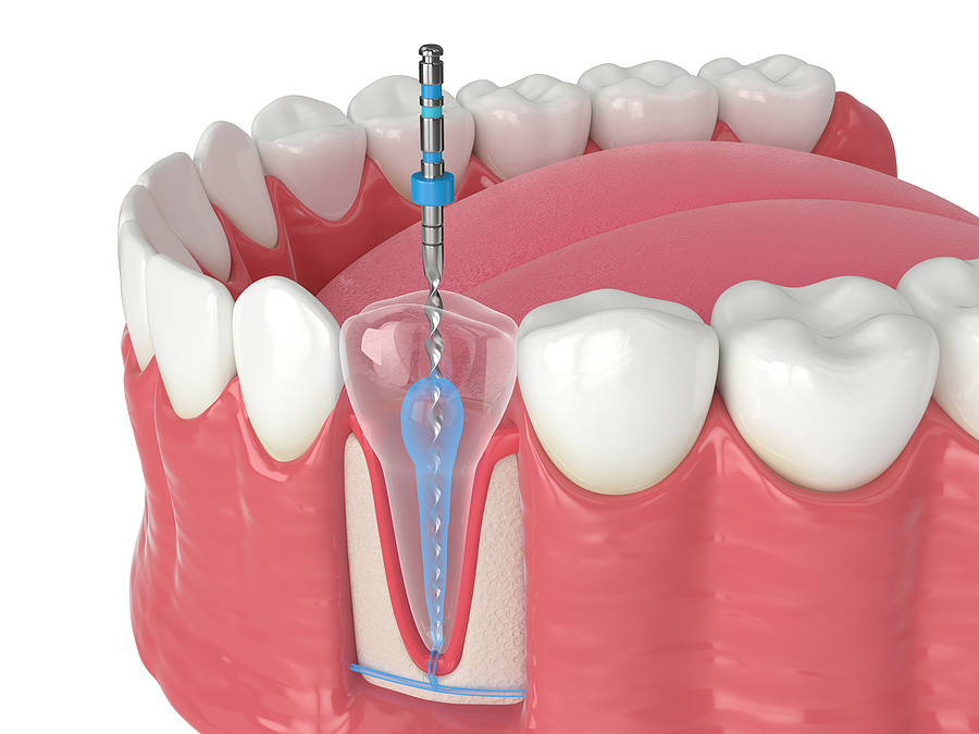 Understanding Limited Endodontics in Salem, OR: Specialized Care for Effective Root Canal Treatment