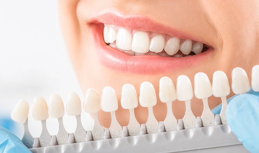 Experience the Convenience of Same Day Crowns / CEREC in Salem, OR: A Modern Dental Solution