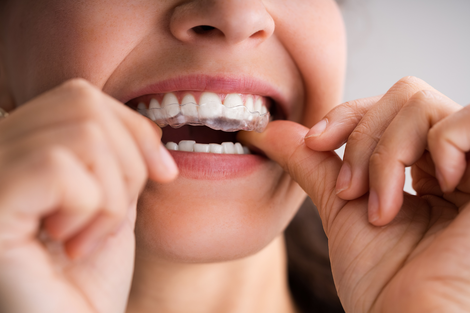 Common Dental Problems That SureSmile Clear Aligners Can Fix