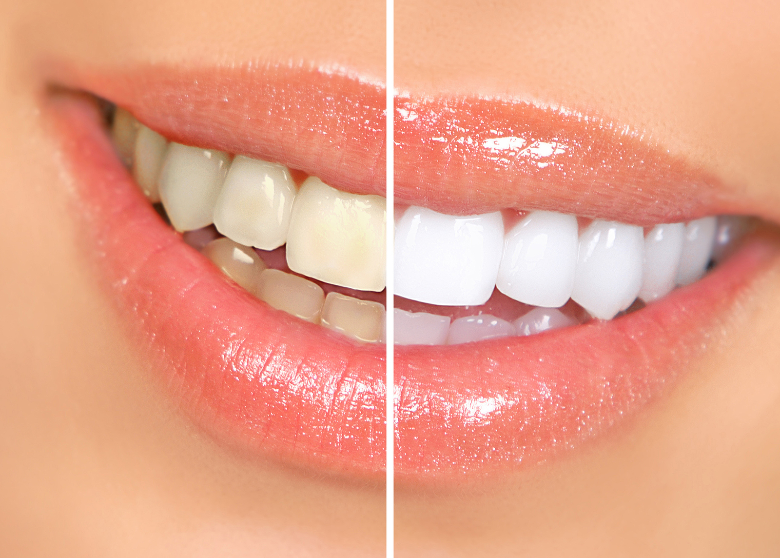 A Brighter Smile Awaits: Comprehensive Guide to Teeth Whitening in Salem, OR